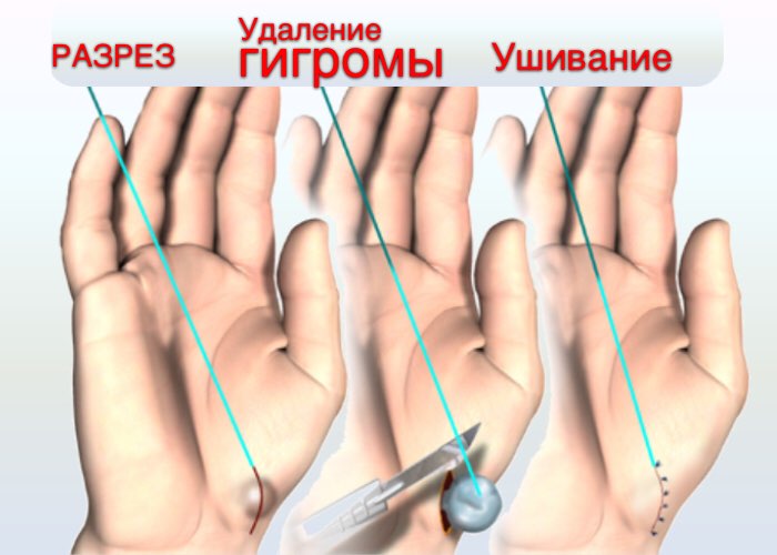 Оперативное удаление гигромы
