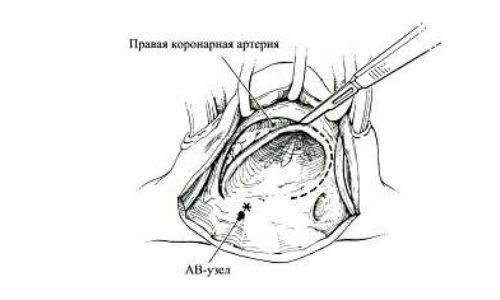 Операция Вольффа сустава