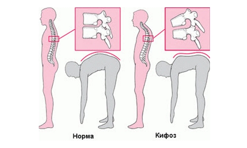 Определение кифоза при наклоне