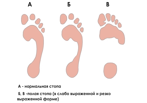 Определение полой стопы по следу