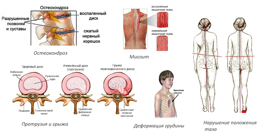 Осложнения кифосколиоза