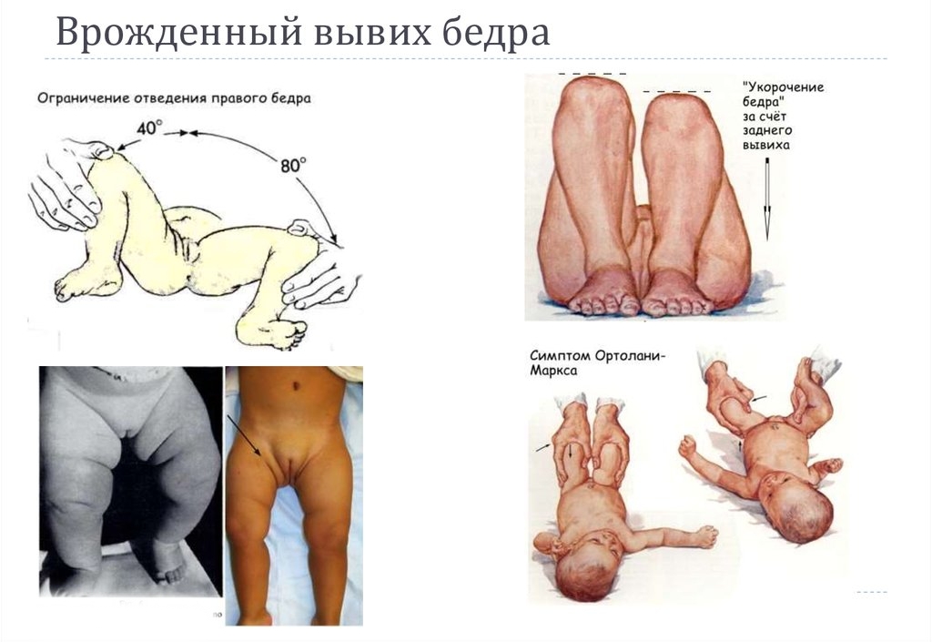 Особенности врожденного вывиха бедра