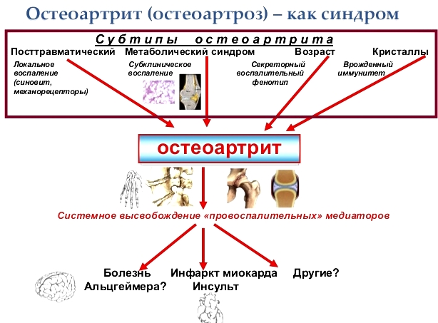 Остеоартрит