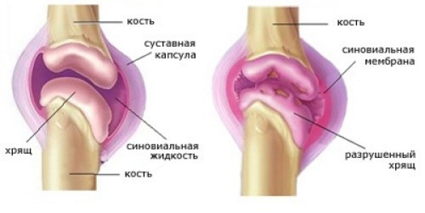 Разрушение хряща и воспаление синовиальной сумки коленного сустава