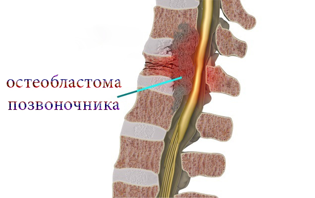 Остеобластома позвоночника