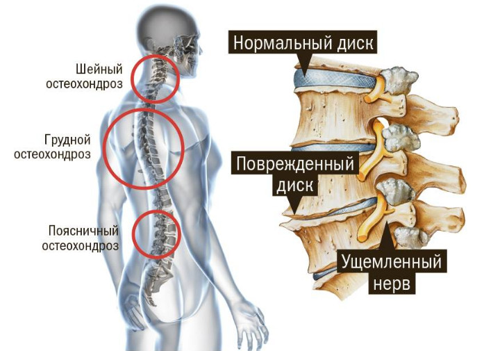 Распространение остеохондроза
