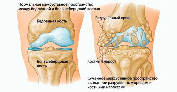 Остеохондроз 