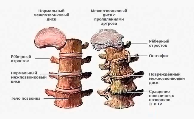 Остеохондроз позвоночника