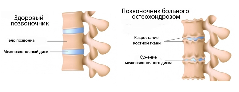 Остеохондроз позвоночника