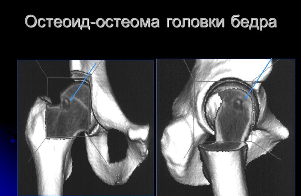 Остеоид-остеома головки бедра