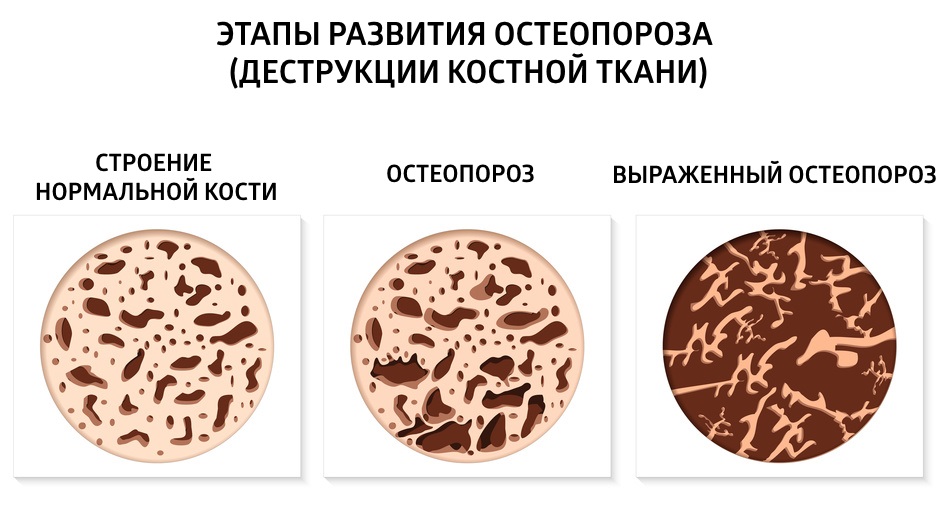 Этапы остеопороза