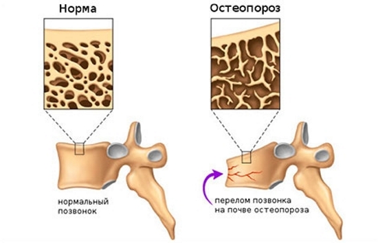 Остеопороз