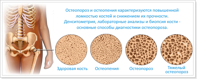 Стадии остеопороза