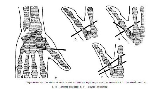 Остеосинтез пальца руки