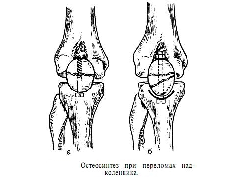 Остеосинтез при переломе коленной чашечки