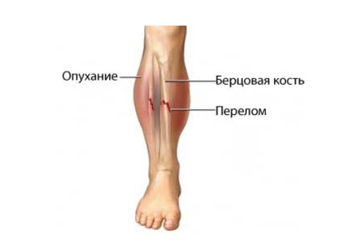 Отек и гематома при переломе берцовых костей