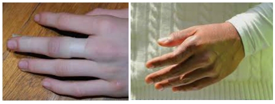 Отек и смещение при переломе пальца