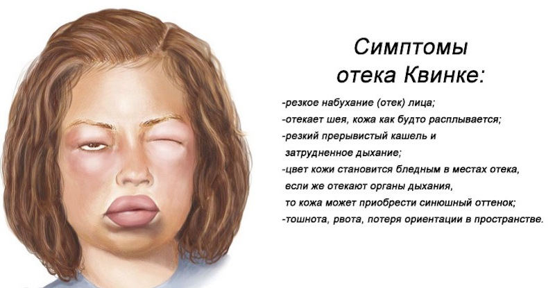 Отек квинке