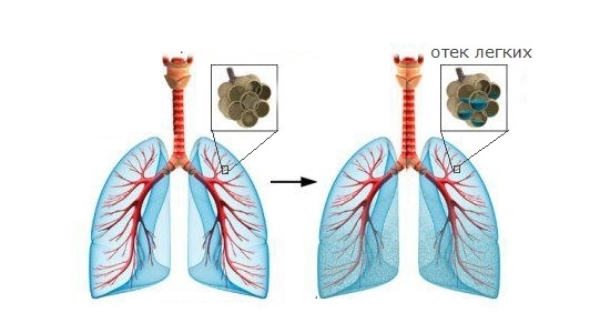 Отек легких