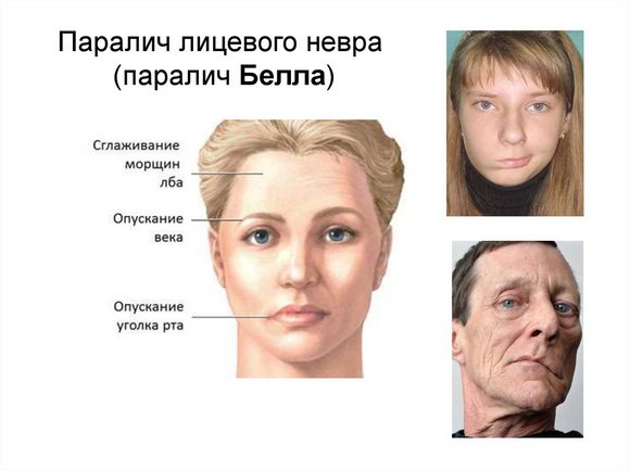 Паралич лица