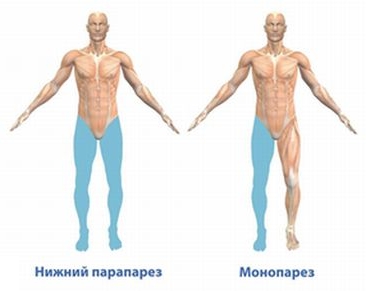 Паралич нижних конечностей