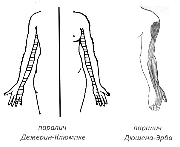Паралич при плексите