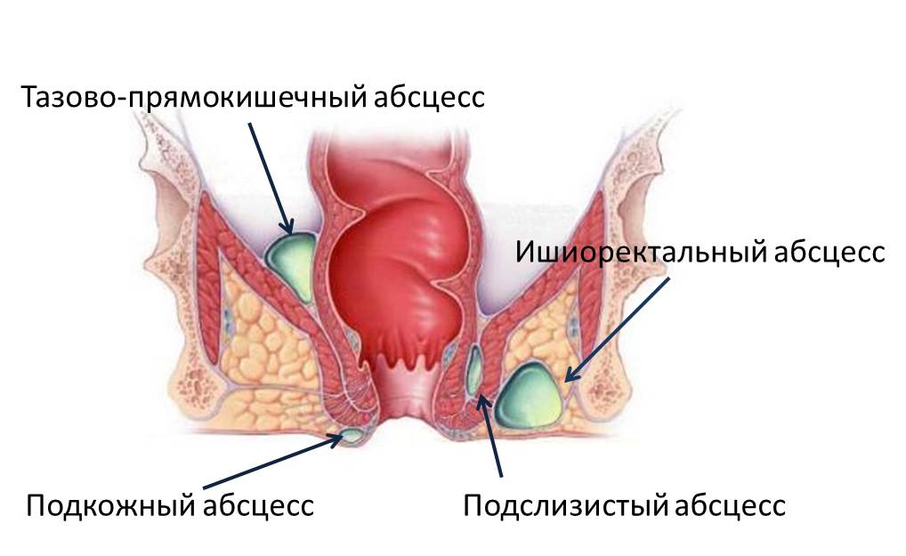 Парапроктит