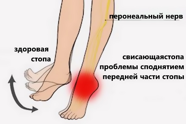 Парез стопы
