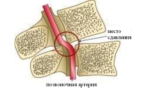 Передавливание артерии при грыже позвоночника