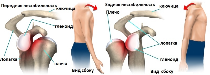 Передняя и задняя нестабильность плечевого сустава