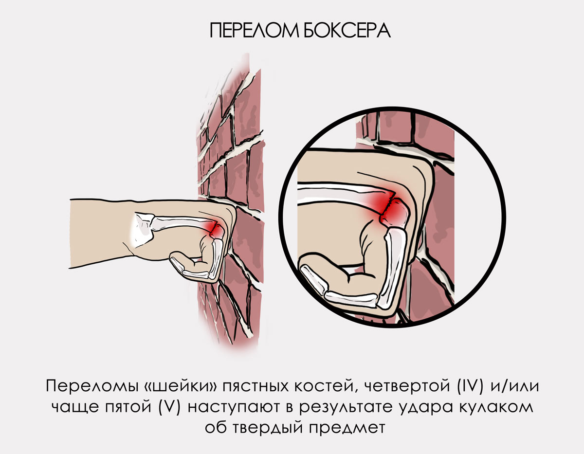 Перелом шейки пястной кости