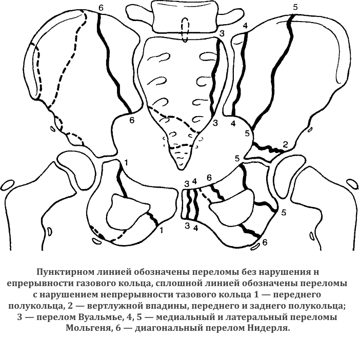 Виды переломов костей таза