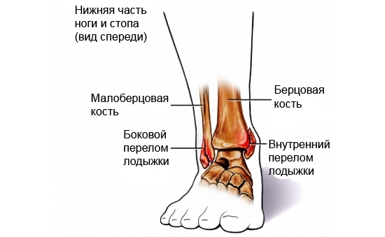 Виды переломов голеностопа и лодыжки