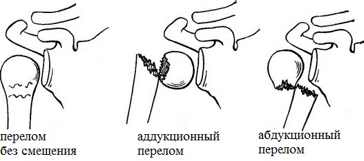 Виды переломов плеча