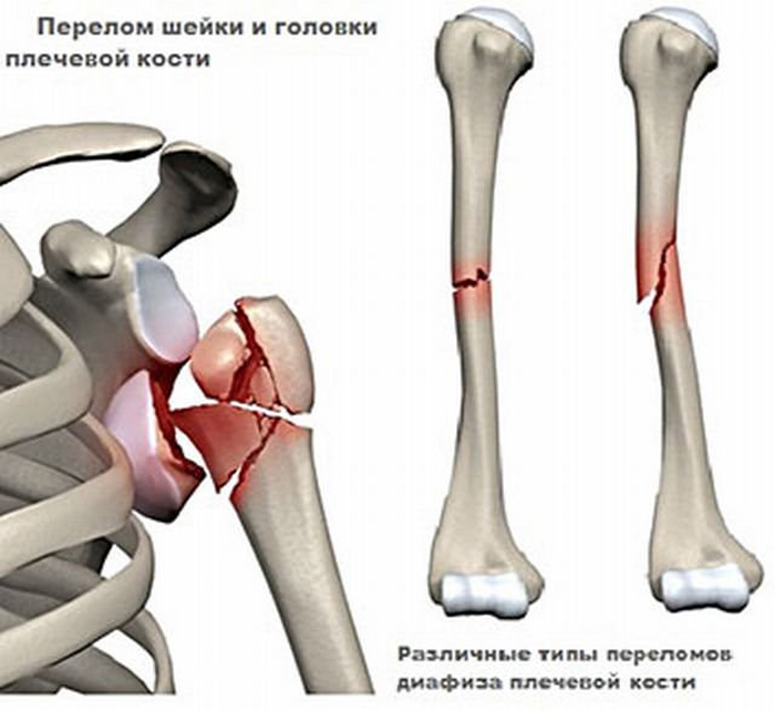 Переломы плечевой кости