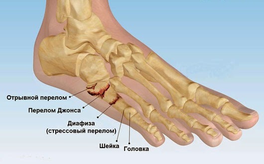 Переломы стопы