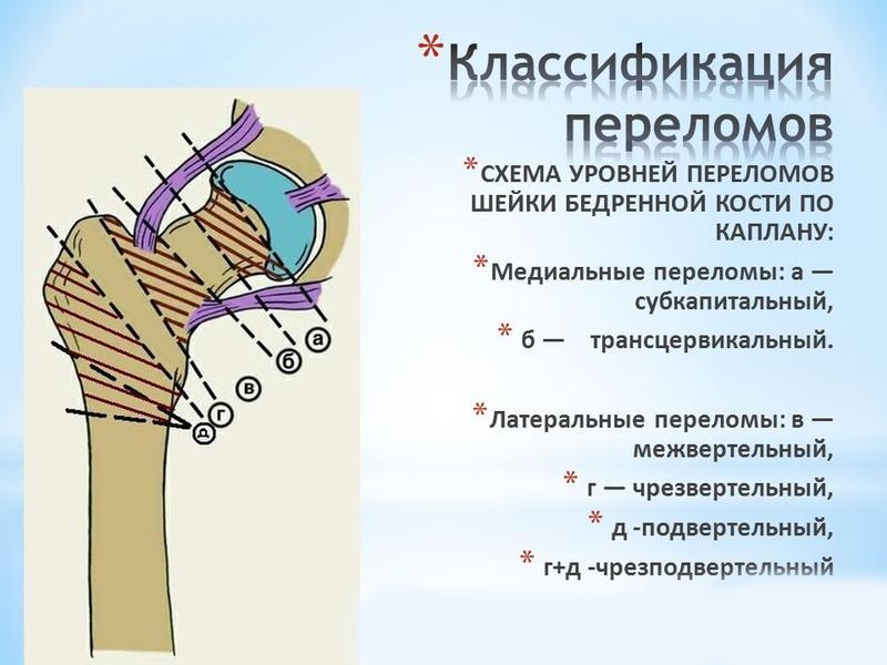 Переломы верхней части бедренной кости