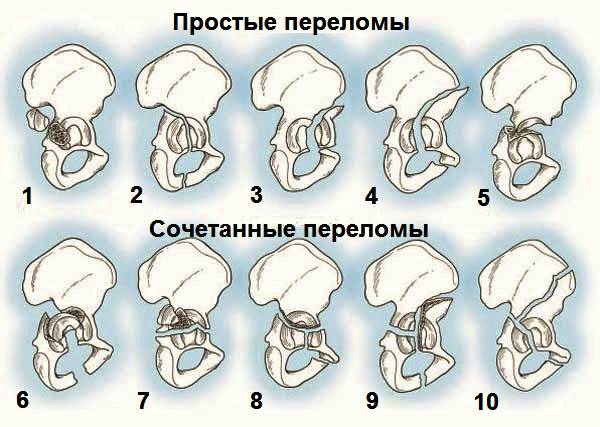 Типы переломов