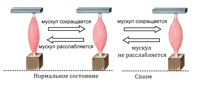 Перенапряжение или спазм мышц