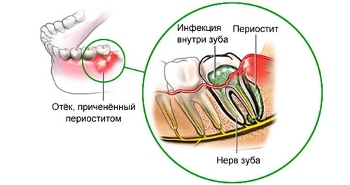 Периостит на фоне кариеса