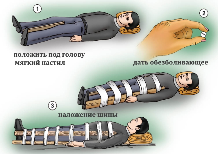 Наложение шины при переломе бедра
