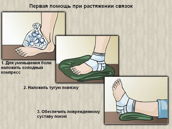 Первая помощь при разрыве связок