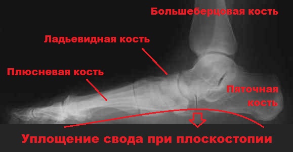 Плоскостопие на рентген снимке