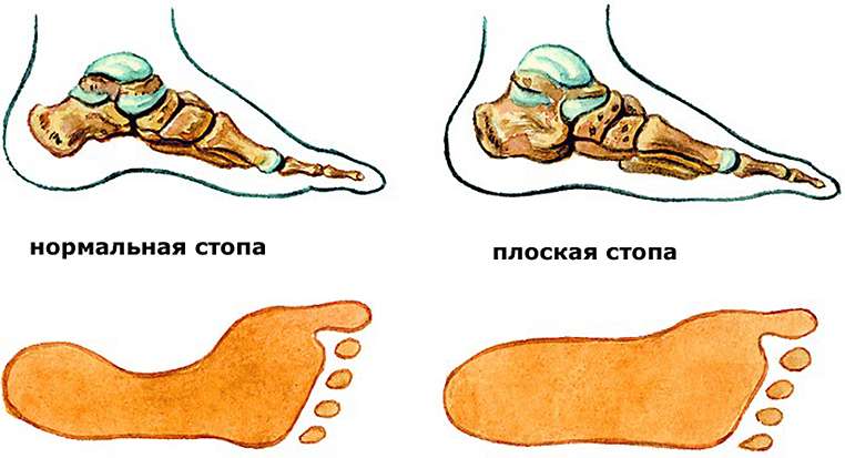 Плоскостопие