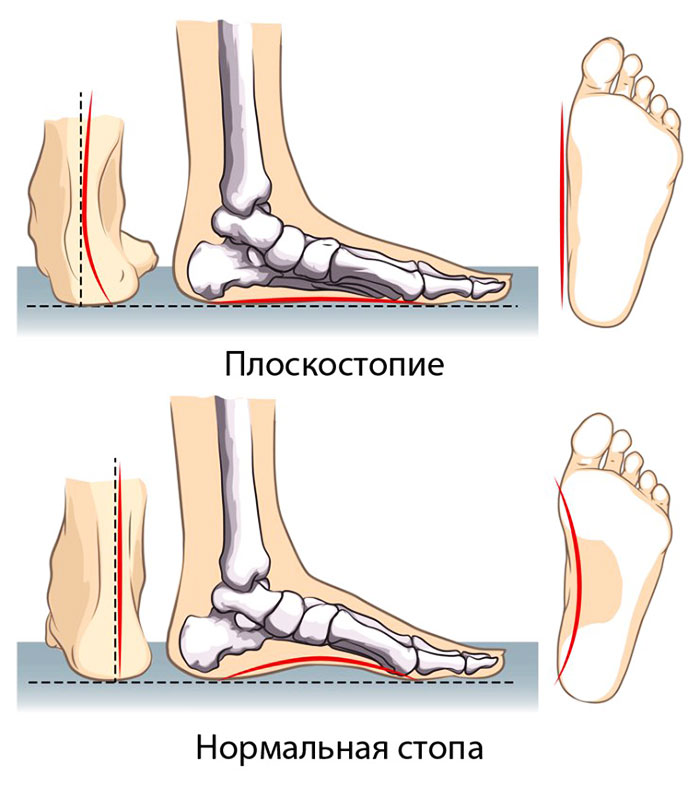 Плоскостопие