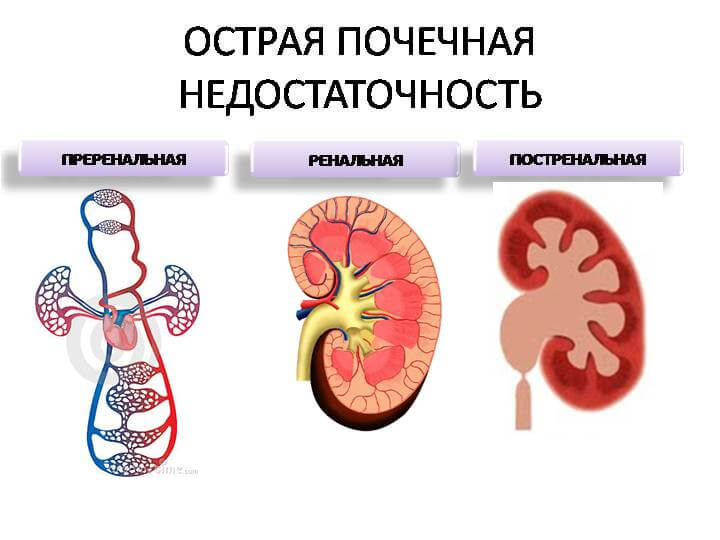 Почечная недостаточность