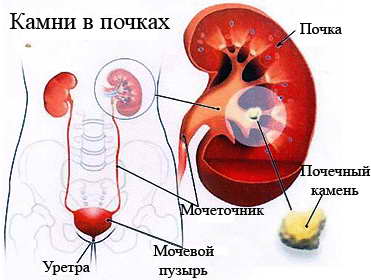 Отложение солей в почках