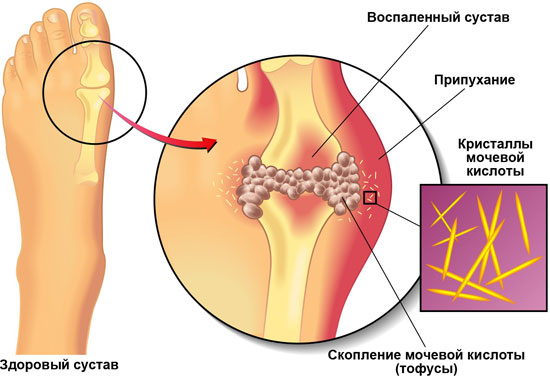 Пирофосфатная артропатия 