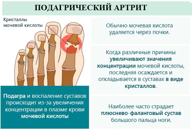 Подагрический артрит