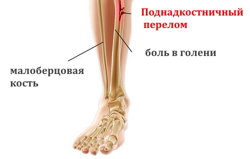 Поднадкостничный перелом голени